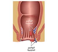 كل ما تريد معرفته عن جراحة البواسير