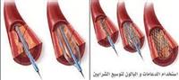  قسطرة الشريان التاجي 